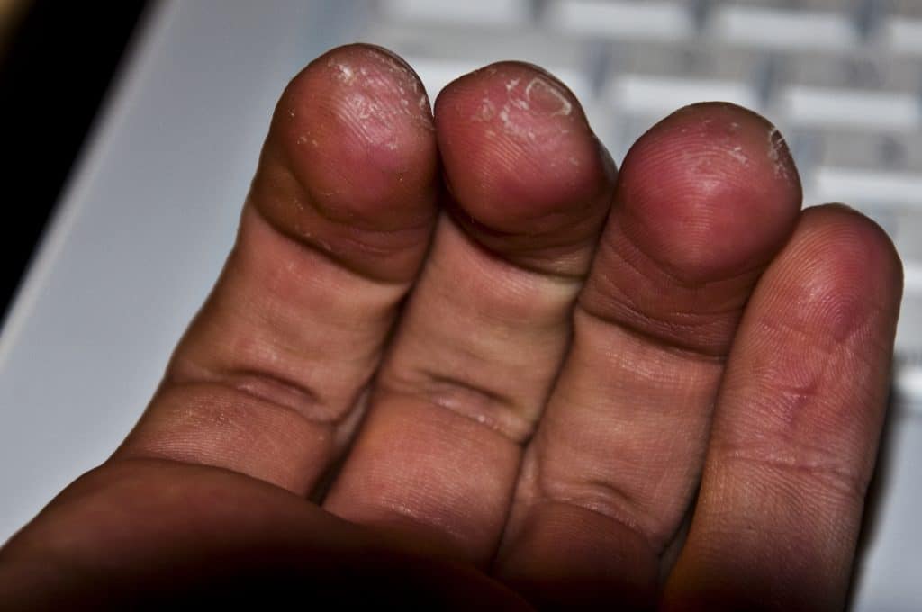 Guitar Calluses (Are They Bad And How To Prevent Them) Guitar Symphony